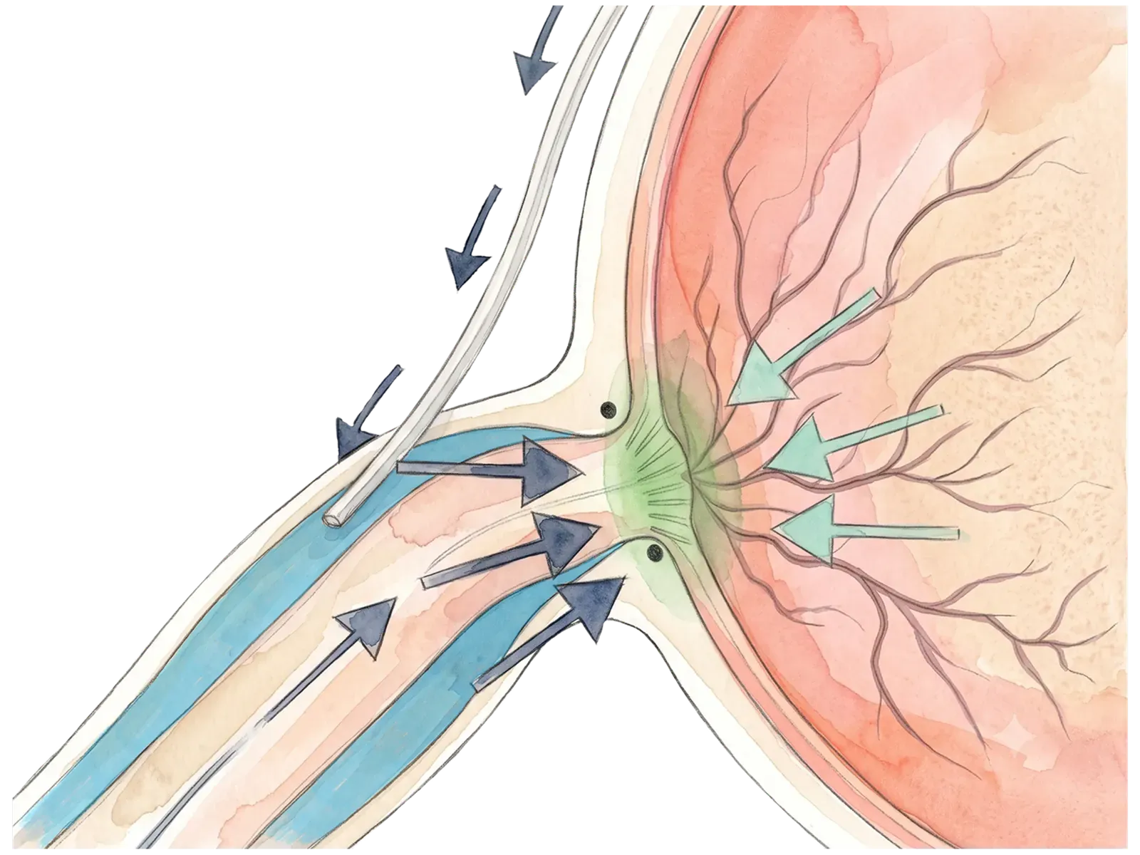 Close-up of the QMAX micro-shunt tube at the optic nerve sheath.