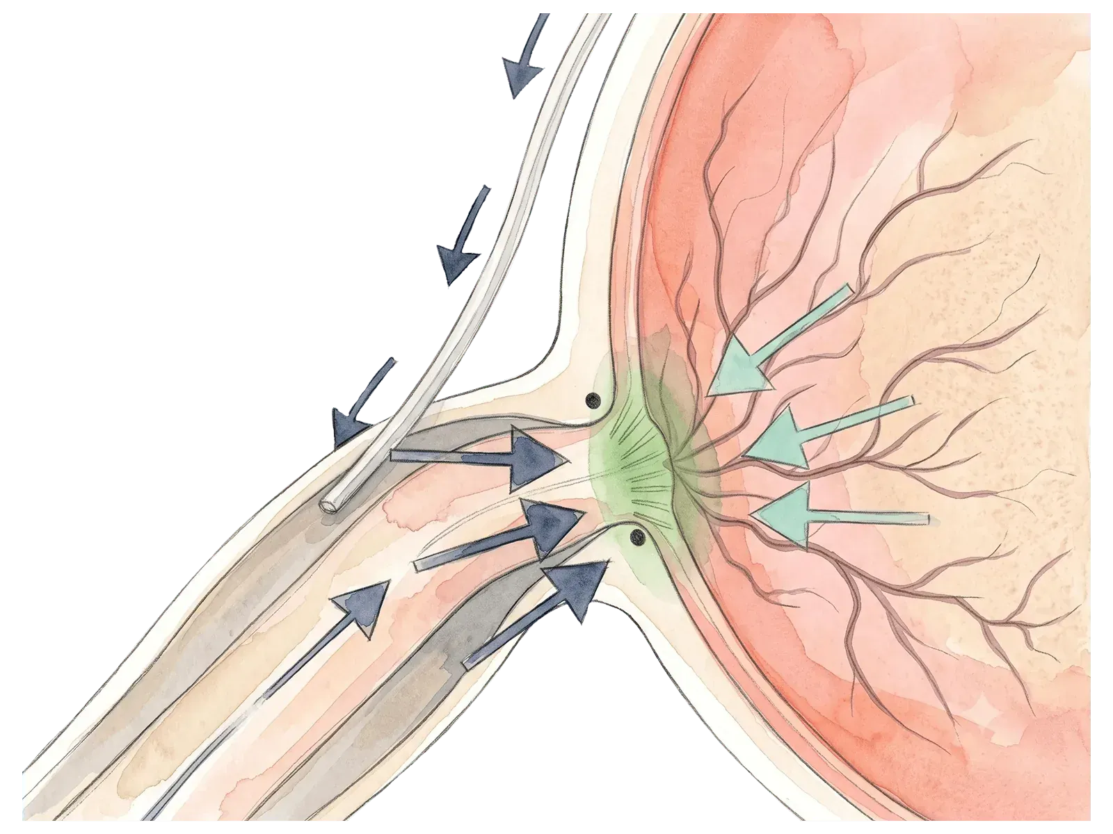 Close-up of the QMAX micro-shunt tube at the optic nerve sheath.