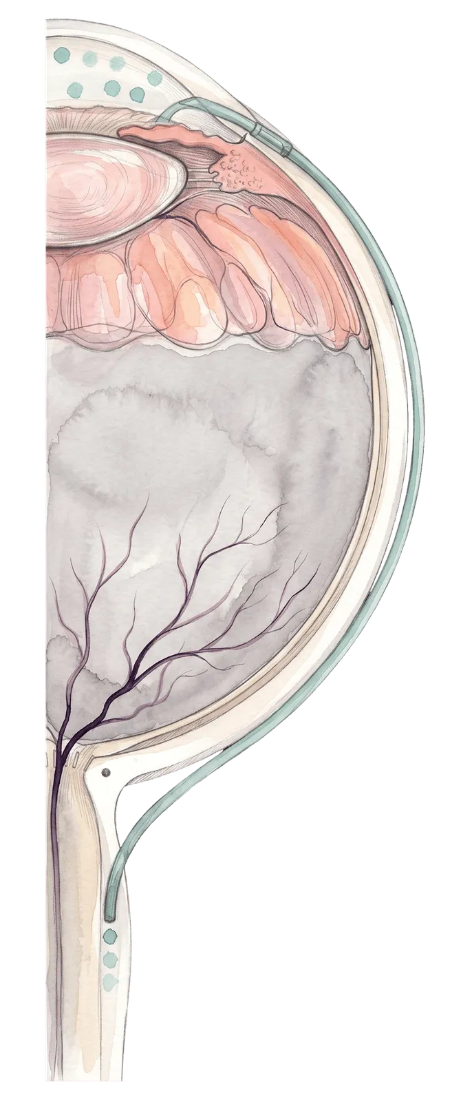 Illustration of QMAX implant position along the optic nerve sheath.