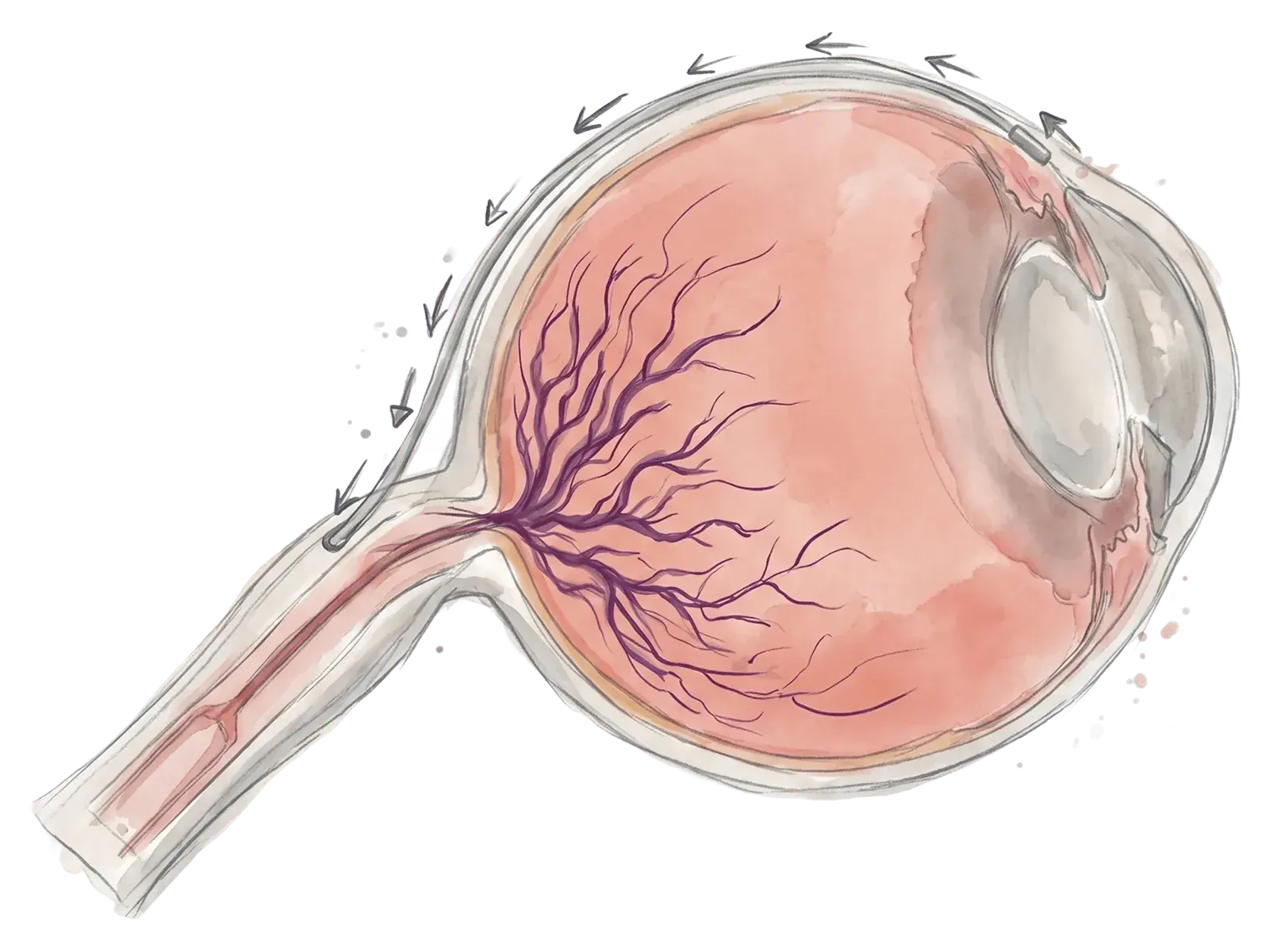 Illustration of QMAX routing fluid to equalize pressure across the optic nerve.
