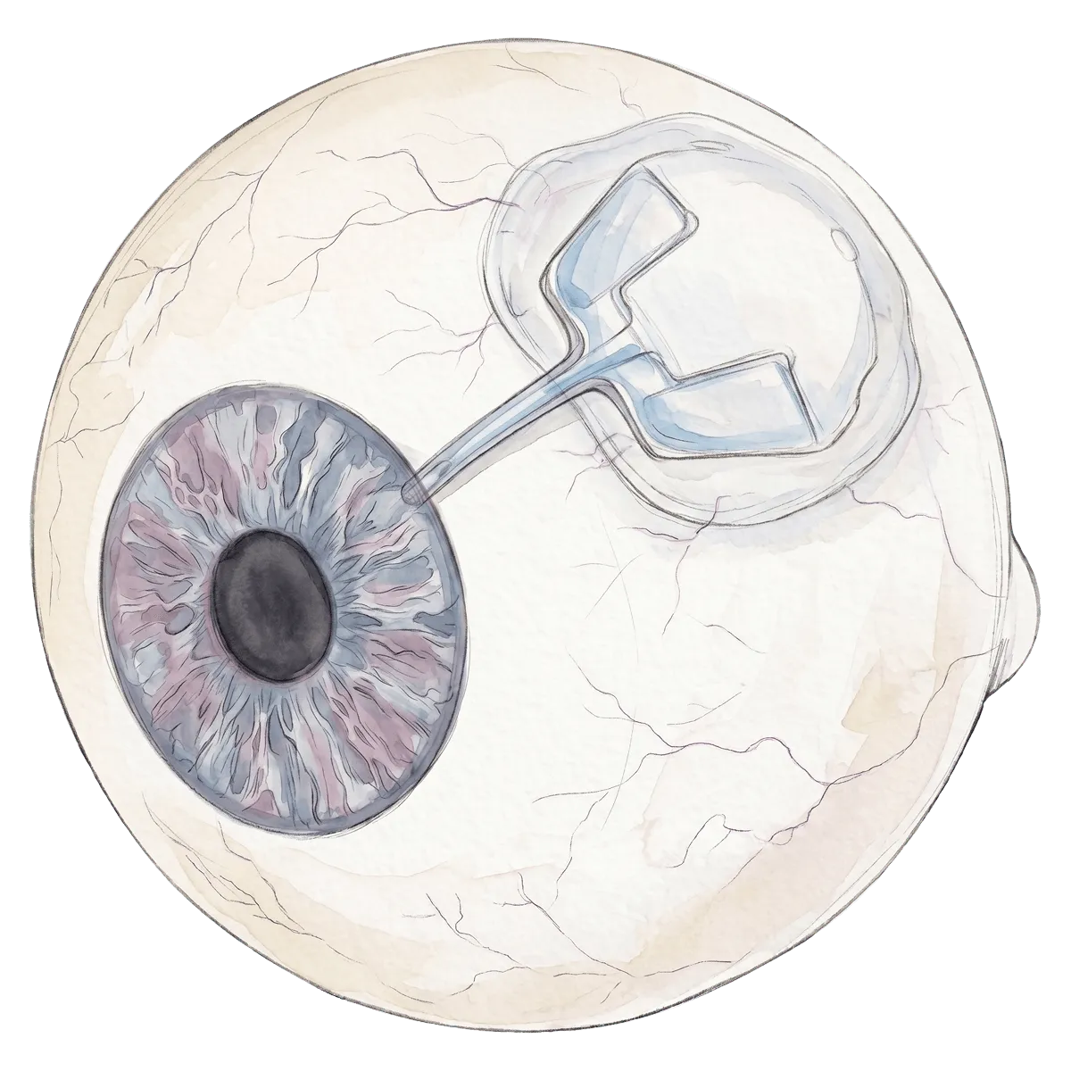 Illustration of QMAX shunt placement on the eye surface.