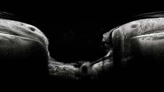 Optic nerve head — glaucoma-associated cupping