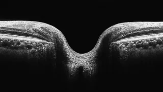 Optic nerve head — healthy balanced pressure