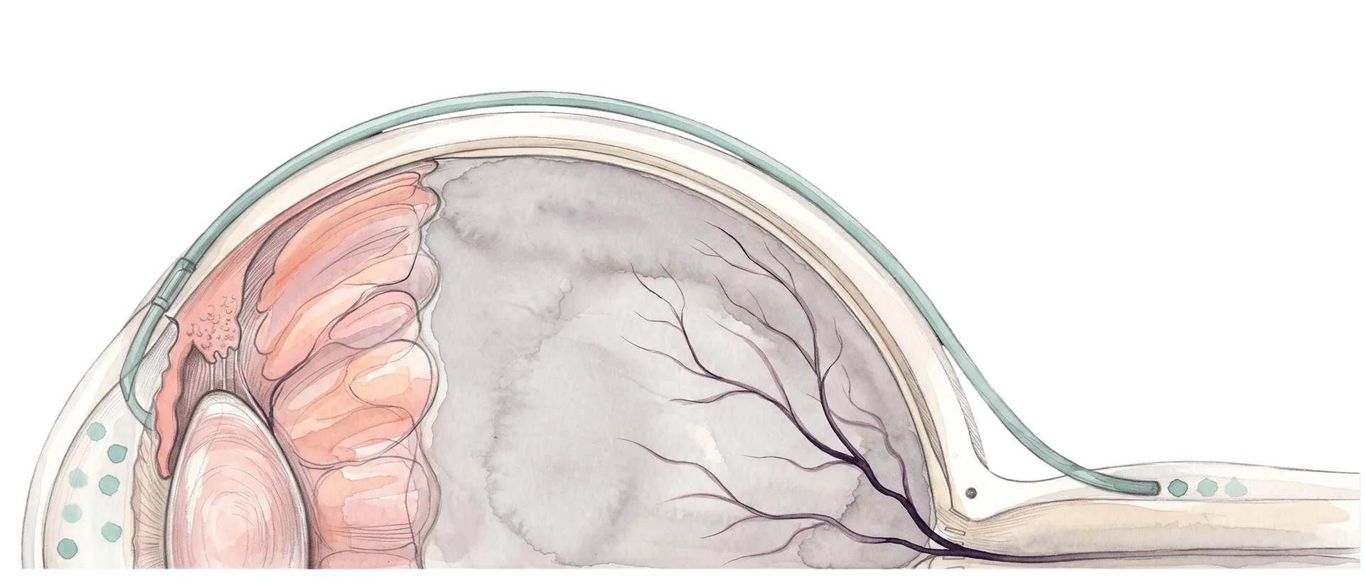 Cross-section of QMAX implant equalizing pressure at the optic nerve head.